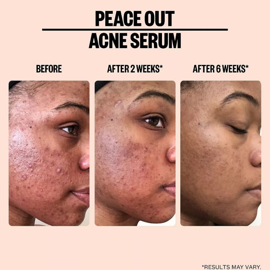 * Treatments | Peace Out Salicylic Acid Acne Treatment Serum