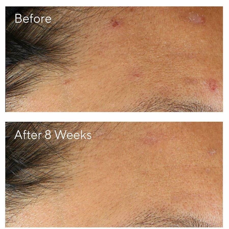 * Treatments | Murad Invisiscar Post-Acne Resurfacing Treatment