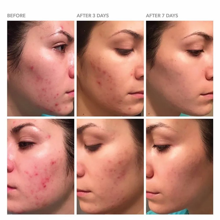 * Treatments | Dr. Dennis Gross Skincare Drx Blemish Solutions Acne Eliminating Gel